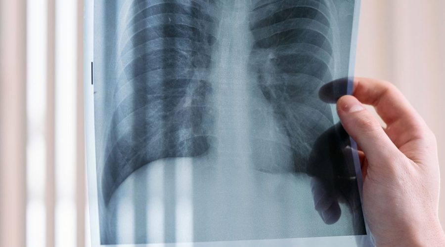 A vertical shot of a doctor's hand holding a lung x-ray in a medical clinic, focusing on healthcare diagnosis.